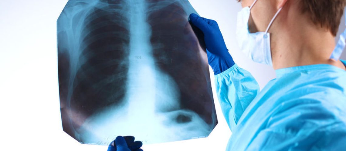 Nódulo pulmonar