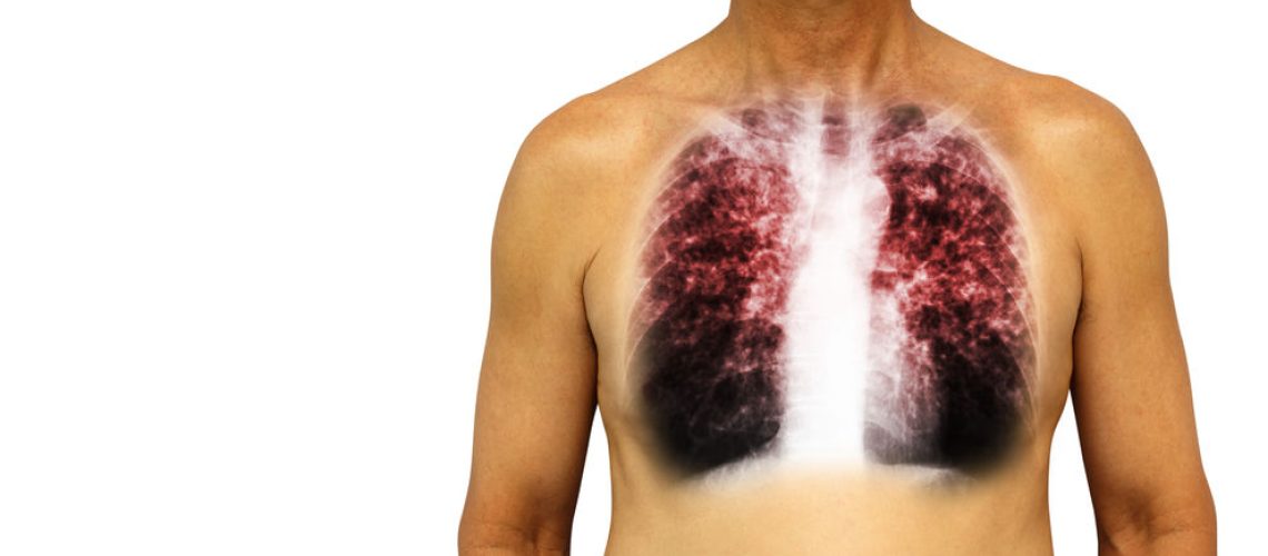 pneumonia necrotizante