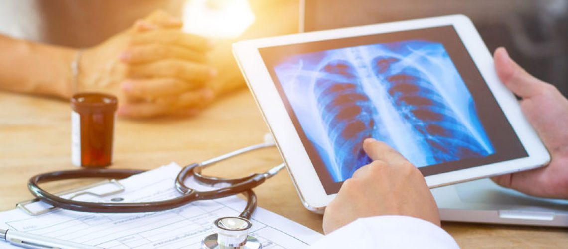 Nódulo Pulmonar