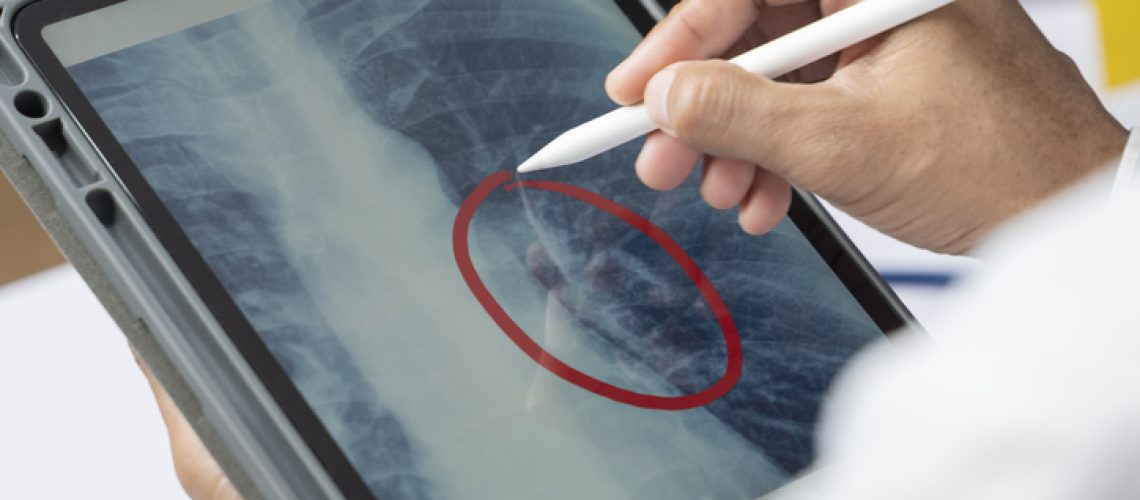 nódulo pulmonar