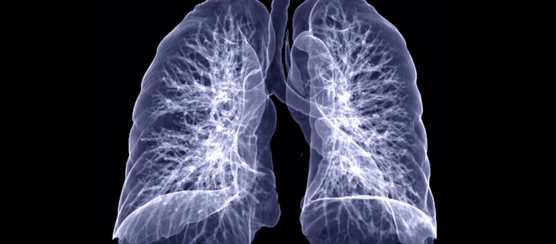 derrame pleural