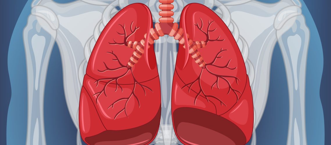 Linfangioleiomiomatose Pulmonar