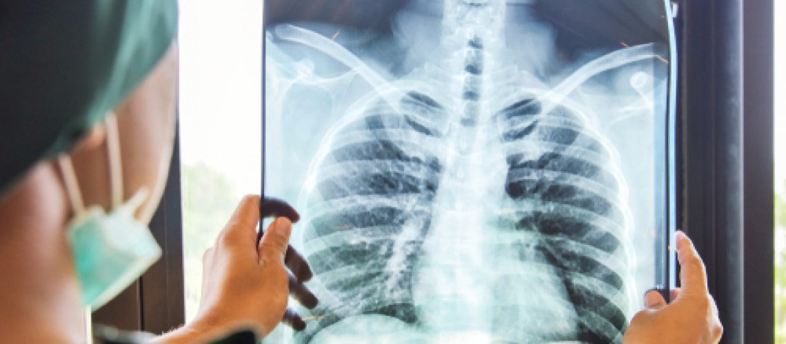 fibrose pulmonar