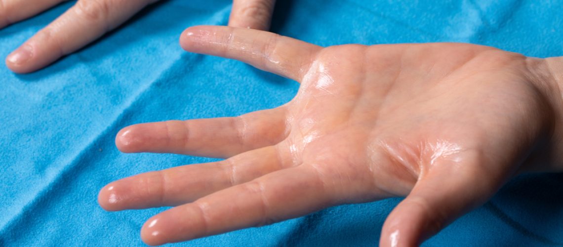 cirurgia para hiperidrose