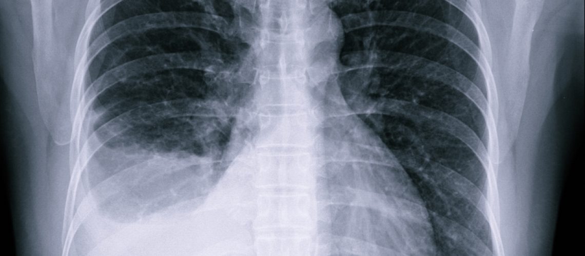 Água na pleura